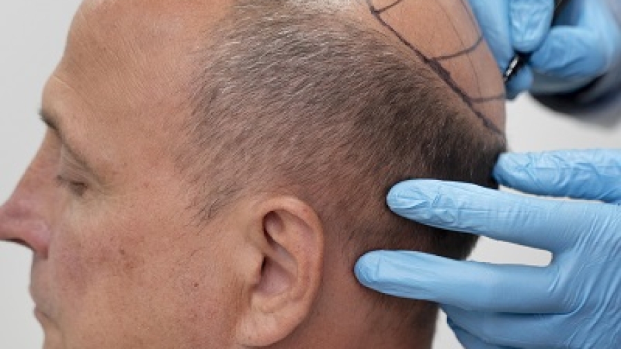 Can Hair Transplants Fix Bald Spots
