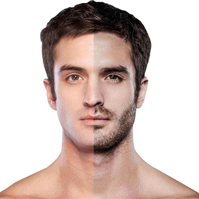 Do Hair Transplants Work For Beards