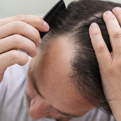 Do hair transplants look natural