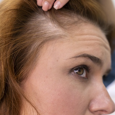 Does PRP Actually Regrow Hair