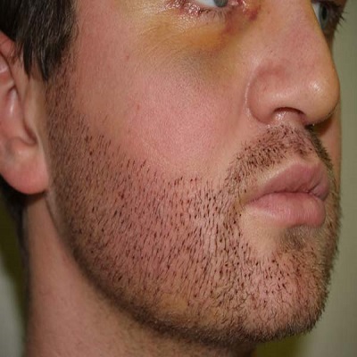 How long does a beard hair transplant take to grow