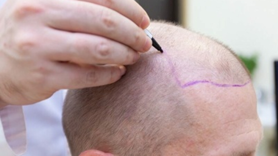 How to Prepare for Hair Transplant Surgery