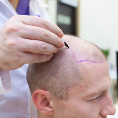 How to Prepare for Hair Transplant Surgery