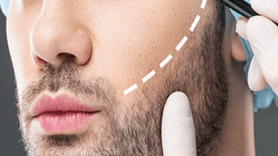 Is beard hair transplant effective and safe