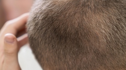 What is the best hair replacement method