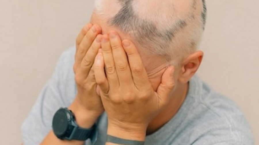 Is FUE Hair Transplant Risky