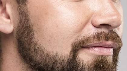 What is the Beard Hair Transplant Success Rate