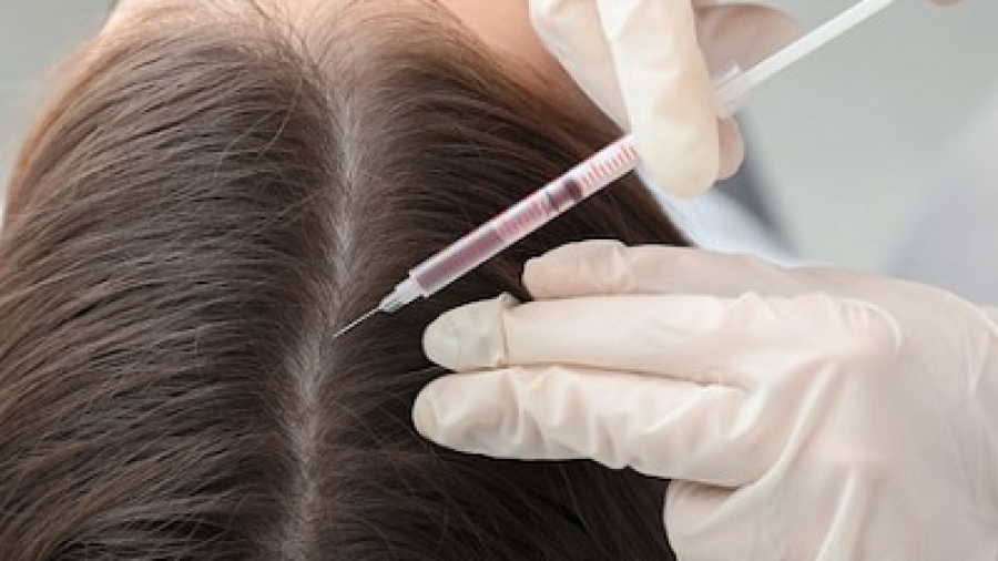 What is the Best Method for Hair Restoration