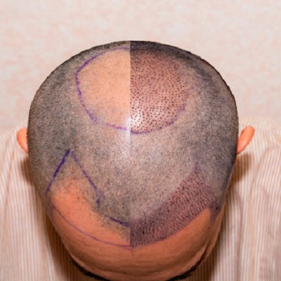 Can Hair Transplants Be Customized for Natural Results?