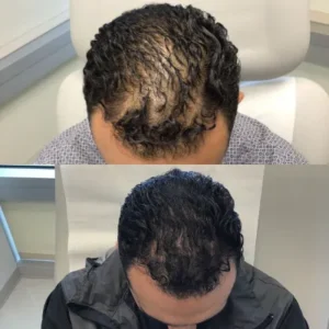 FUE vs. PRP Hair Treatment in Islamabad Which Works Better