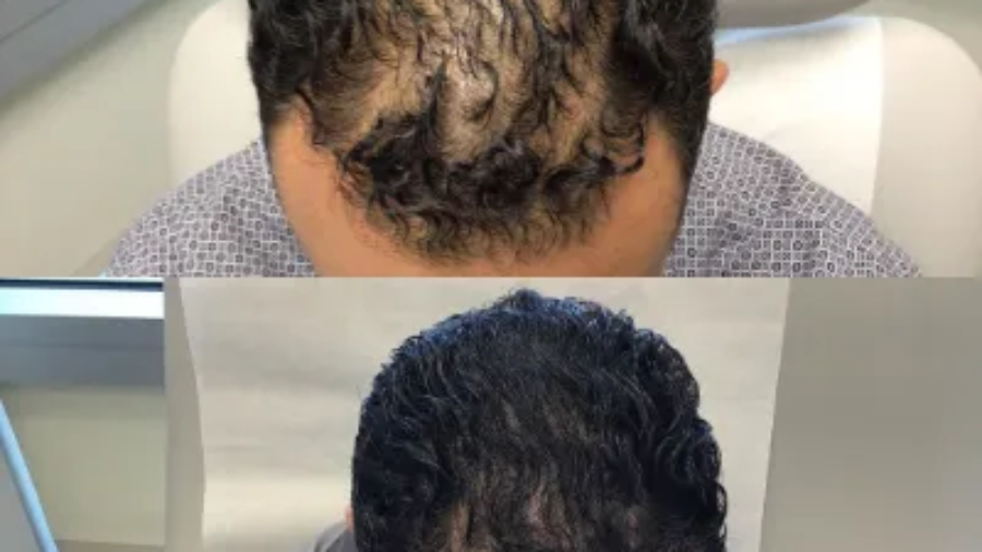 FUE vs. PRP Hair Treatment in Islamabad Which Works Better
