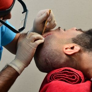 Does FUE Give a Natural Look?