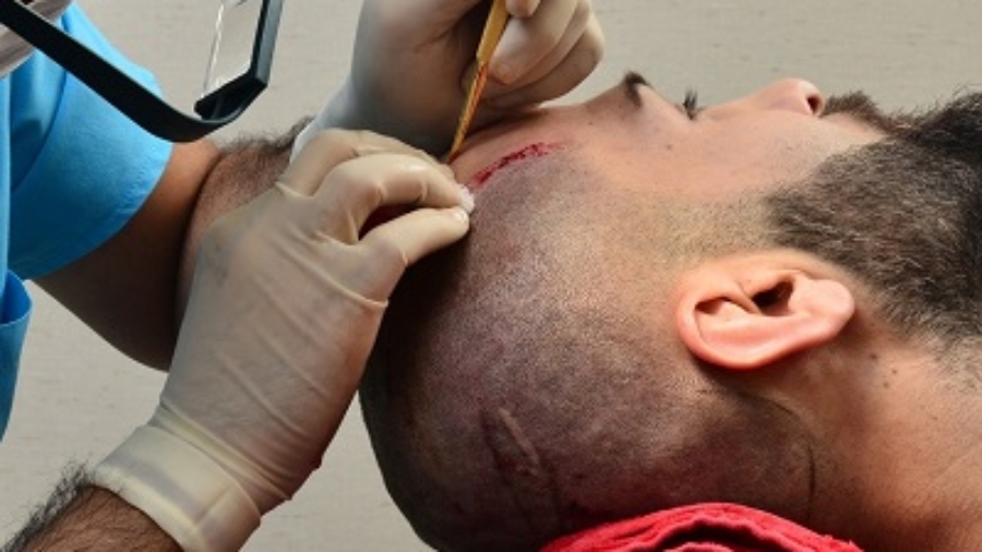 Does FUE Give a Natural Look?