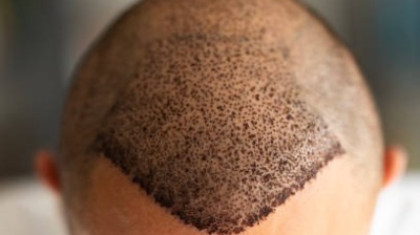 Can a Hair Transplant Be Done Twice.