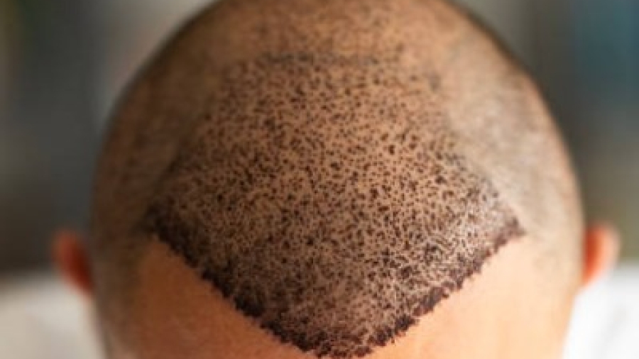 Can a Hair Transplant Be Done Twice.