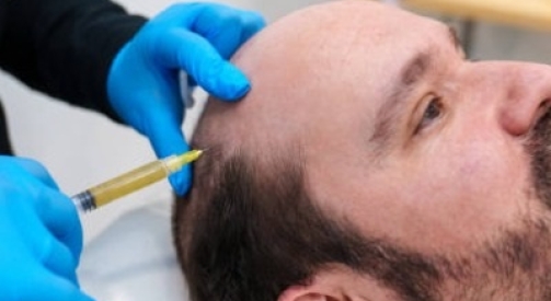 How Long Is Hair Transplant Recovery?