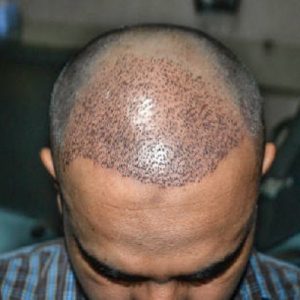 Can Hair Transplant Fix Crown Baldness?