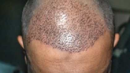 Can Hair Transplant Fix Crown Baldness?