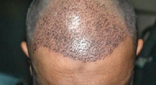 Can Hair Transplant Fix Crown Baldness?