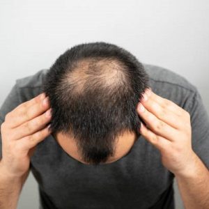 Does Hair Transplant Look Natural?