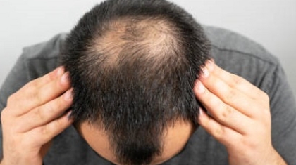Does Hair Transplant Look Natural?