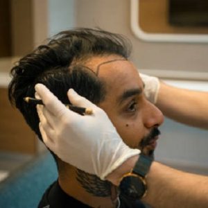 “Hair Restoration Reinvented: The Rise of Advanced Transplants”