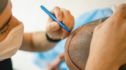Can Hair Transplants Treat Receding Hairlines Effectively?