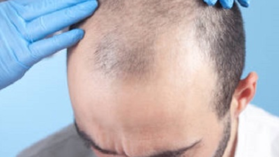 How Long Does Hair Take to Grow After Surgery?