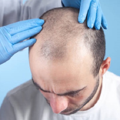 How Long Does Hair Take to Grow After Surgery?