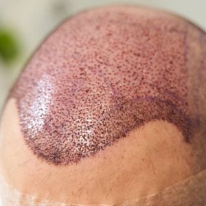 How Painful Is a Hair Transplant Procedure?