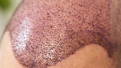 How Painful Is a Hair Transplant Procedure?