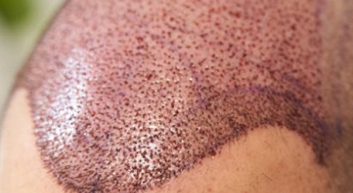 How Painful Is a Hair Transplant Procedure?