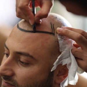 Can Hair Transplants Treat Receding Hairlines Effectively?