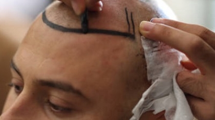 Can Hair Transplants Treat Receding Hairlines Effectively?