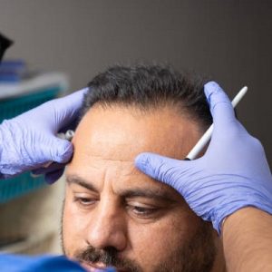 Can You Regrow Confidence with a Hair Transplant in Islamabad?