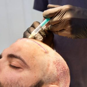 FUE vs. FUT: Which Hair Transplant Is Better?