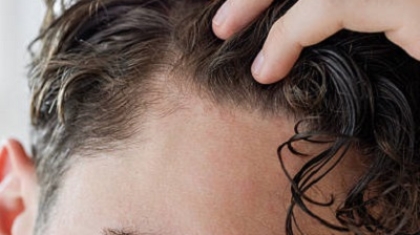Can Hair Transplants Be Customized for Natural Results?