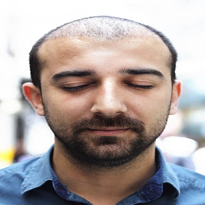 Can Hair Transplant Improve Facial Appearance
