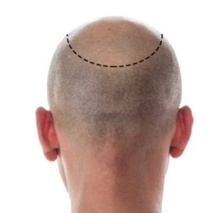 Do Hair Transplants Really Stop Permanent Baldness
