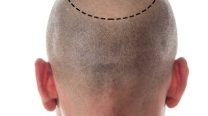 Do Hair Transplants Really Stop Permanent Baldness