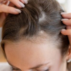Does Hair Transplant Stop Future Hair Loss?