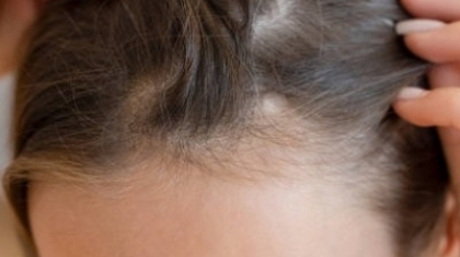 Does Hair Transplant Stop Future Hair Loss?