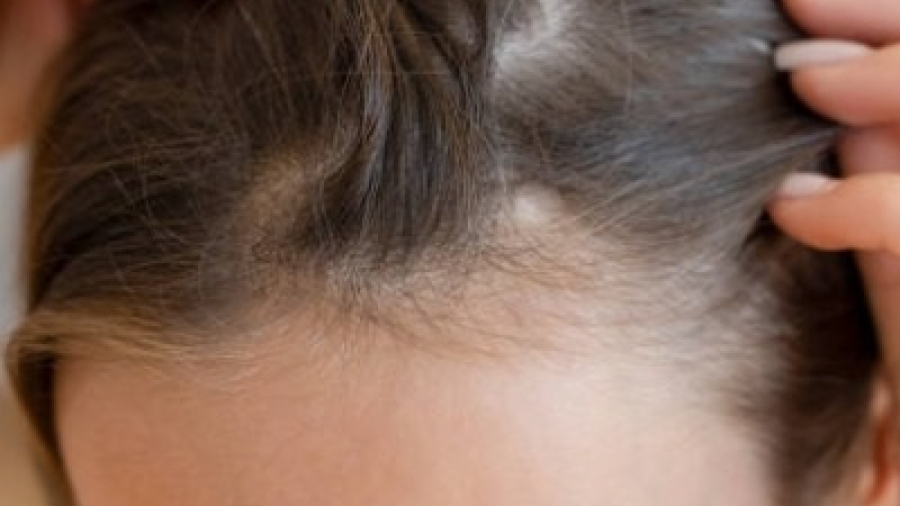 Does Hair Transplant Stop Future Hair Loss?