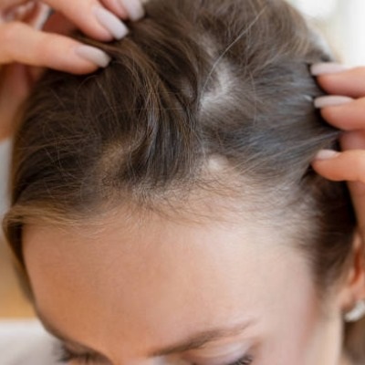 Does Hair Transplant Stop Future Hair Loss?