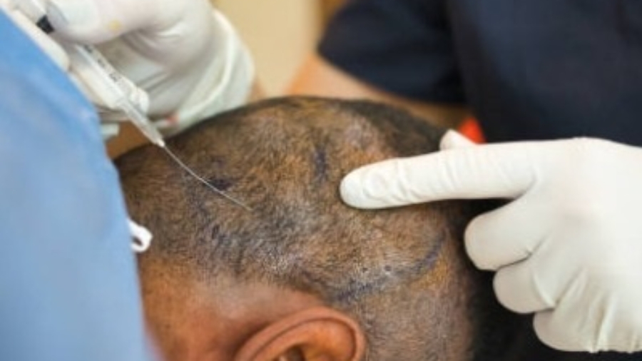 Hair Transplant Designed for Natural Growth