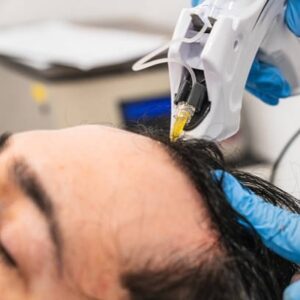 Hair Transplant Success with Advanced Techniques