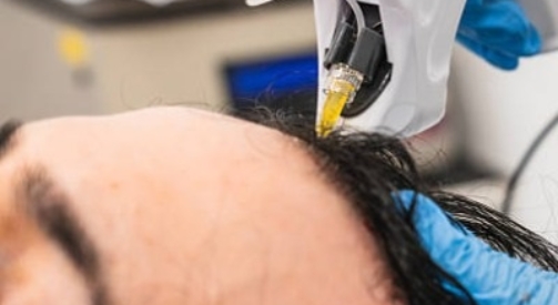 Hair Transplant Success with Advanced Techniques