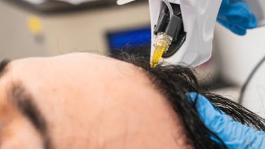 Hair Transplant Success with Advanced Techniques