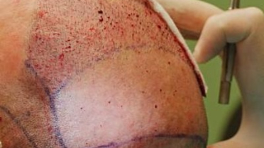 How Hair Transplant Helps Restore Hair Density