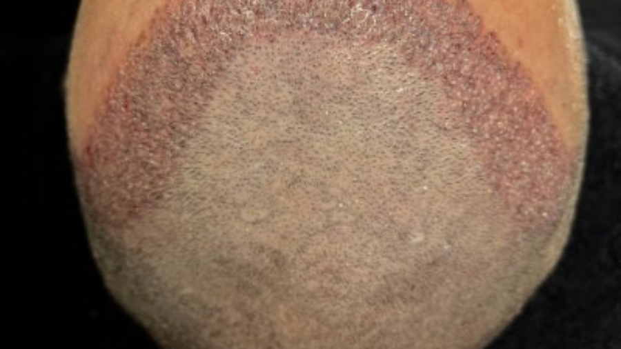 How Hair Transplant Improves Hair Density Naturally